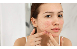 Acneea - Tipuri de Acnee, Cauzele Acneei, Tratament - skinseen.ro