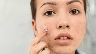 Ten acneic: ce reprezintă și cum poți combate eficient simptomele acestei probleme dermatologice - skinseen.ro