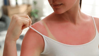 Cum ai grijă de pielea ta când te confrunți cu arsuri solare — sfaturi pentru calmare și protecție pe termen lung - skinseen.ro