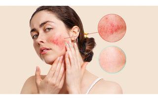 Rozacee. Tratament si Preventie - skinseen.ro